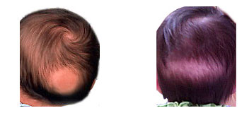 hair growth during pregnancy gender